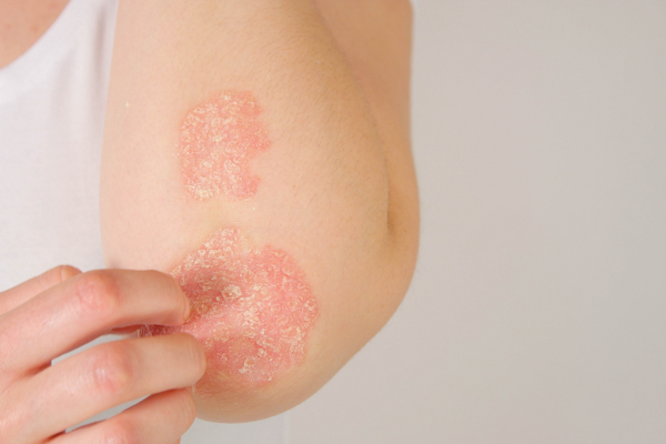 Psoriasis Treatment